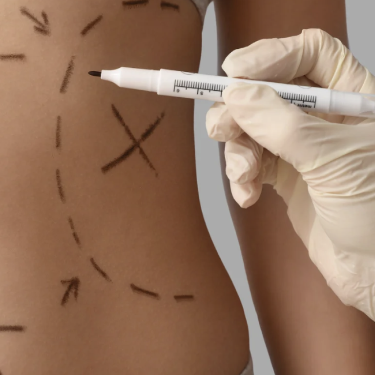360 Liposuction Near Arlington VA